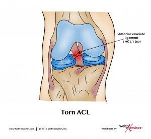 Knee ACL Tear